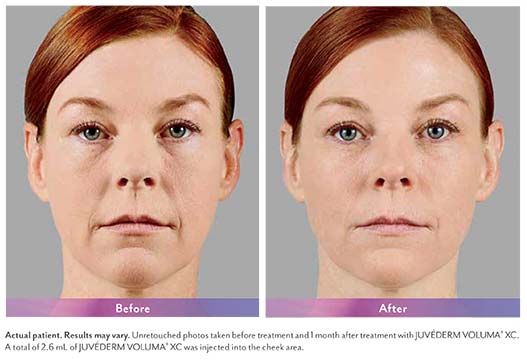 Juvederm® in Avon, CT | Dr. Colleen Jambor